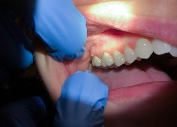 Best Dentist for Tooth Abscess  in Kaufman, TX