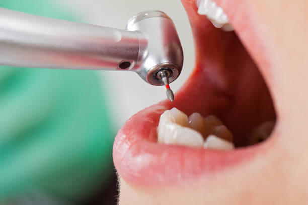 Best Dentist for Tooth Abscess  in Kaufman, TX